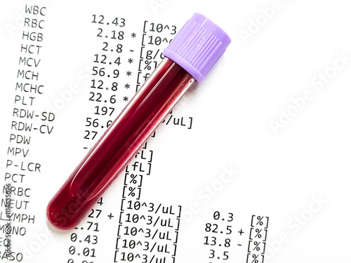 Closeup of blood sample isolated with abnormal CBC report. Anemia, Hemolytic anemia. Low RBC (Hb).