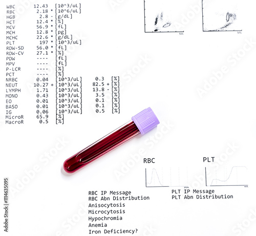 Closeup of blood sample isolated with abnormal CBC report. Anemia, Hemolytic anemia. Low RBC (Hb). photo