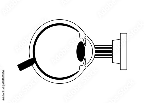 LASIK eye surgery