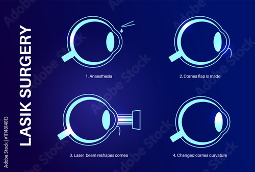 LASIK eye surgery