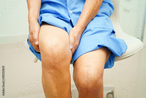 Asian elderly woman patient with scar knee replacement surgery in hospital. photo