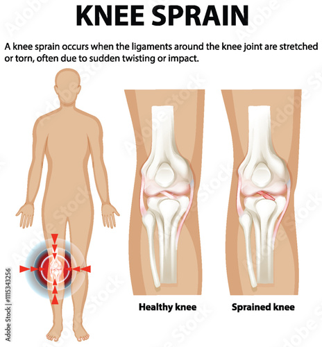 Understanding Knee Sprain and Ligament Injury