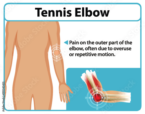 Understanding Tennis Elbow Pain