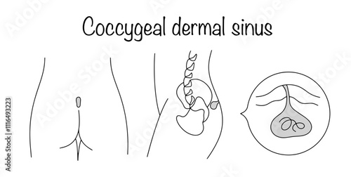 Coccygeal dermal sinus