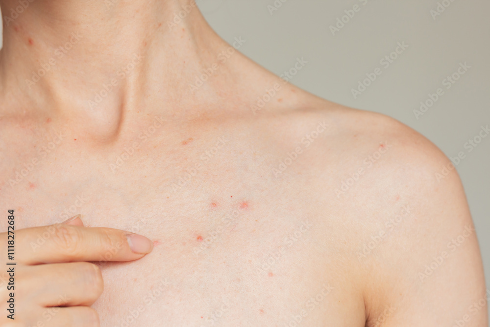 Close-up photo of a young woman suffering acne in the chest and neck, showing her index finger on acne. Skin diseases. Hormonal disorders. Close-up photo of a young woman suffering acne in the chest and neck, showing her index finger on acne. Skin diseases. Hormonal disorders.