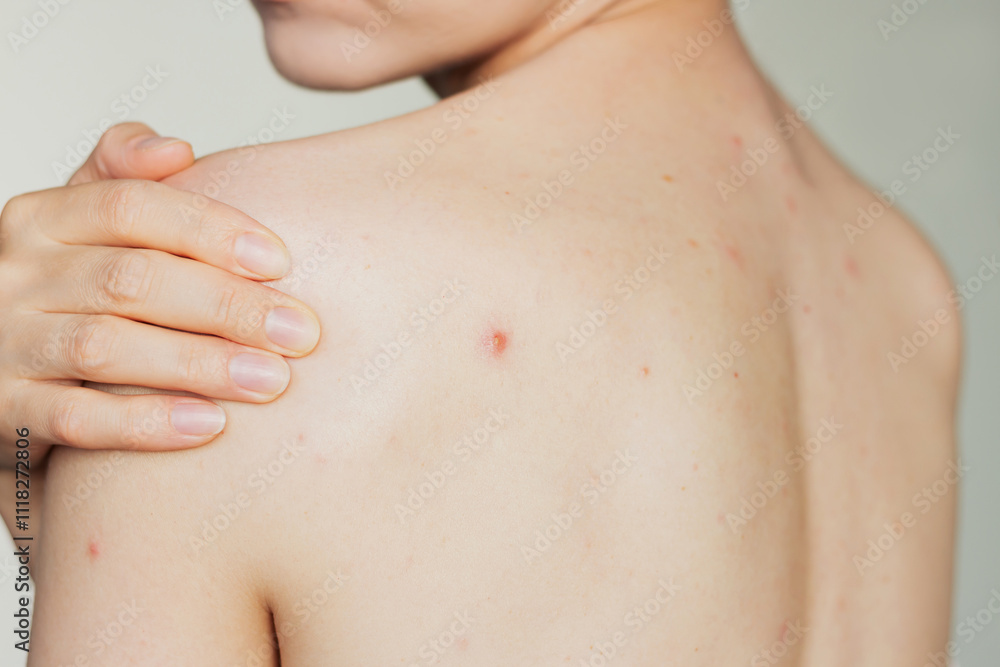 Young woman suffering acne on her back, demonstrating a big pimple on her shoulder blade. Skin diseases. Hormonal disorders. Young woman suffering acne on her back, demonstrating a big pimple on her shoulder blade. Skin diseases. Hormonal disorders.
