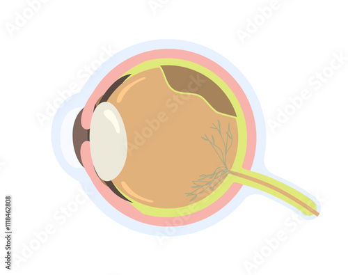 Eye with retinal detachment vector illustration. Detached retina after trauma injury