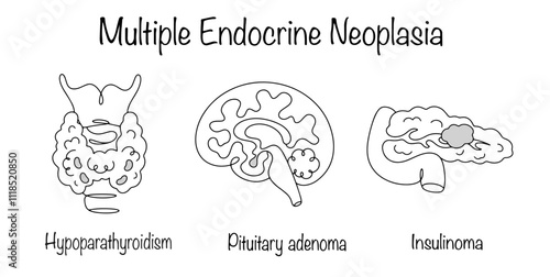 Multiple Endocrine Neoplasia