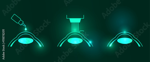 LASIK eye surgery