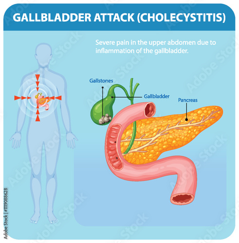 Understanding Gallbladder Attack and Cholecystitis