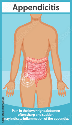 Understanding Appendicitis and Its Symptoms