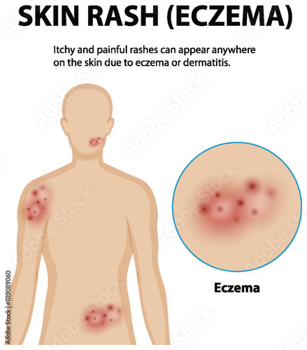 Understanding Eczema and Skin Rashes