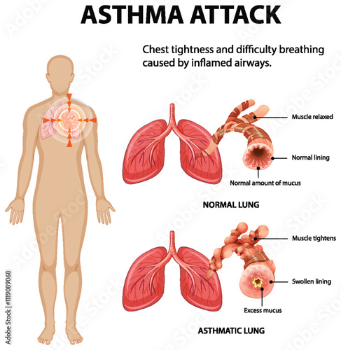 Understanding Asthma and Its Effects