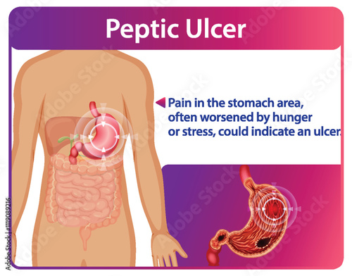 Understanding Peptic Ulcers and Symptoms