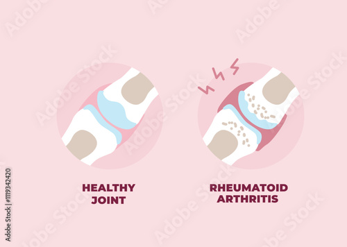 Healthy and inflamed joint affected by Rheumatoid Arthritis. Vector illustration in flat style.