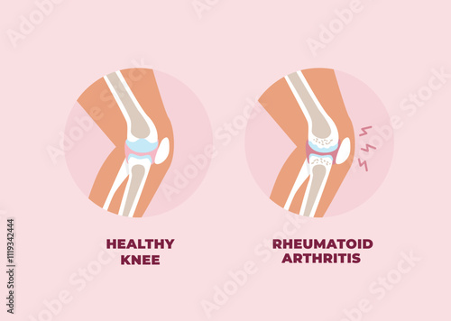 Healthy knee and inflamed knee joint affected by Rheumatoid Arthritis. Vector illustration in flat style.