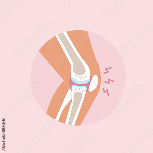 An inflamed knee joint in pain isolated icon. Rheumatoid Arthritis. Vector illustration in flat style.