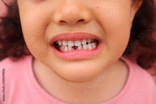 An Asian female toddler shows her newly knocked out teeth and looks toothless, close up.
