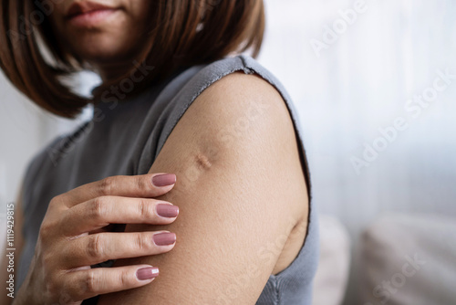 Фотография closeup monkeypox and smallpox vaccine scar on woman's arm