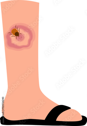 Lyme disease Illustration 