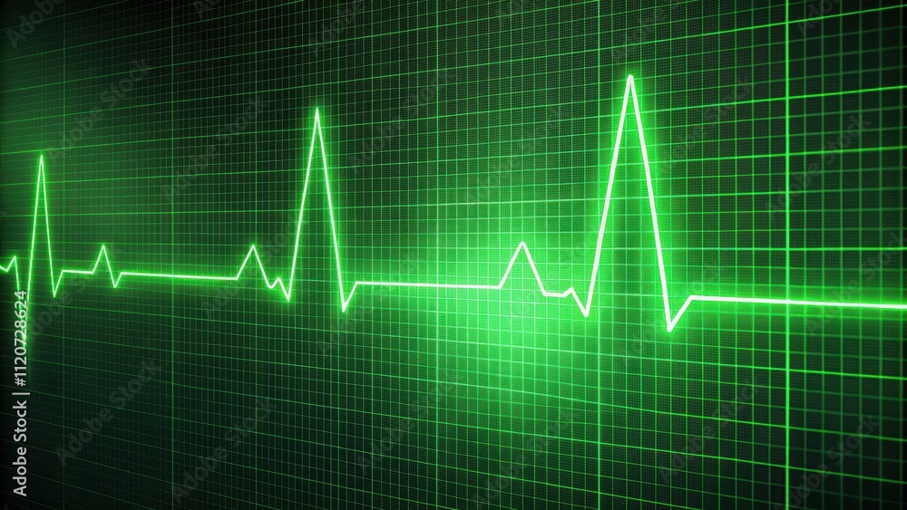 EKG green wave tracing displayed on ICU monitor, EKG, electrocardiogram, green, wave, tracing, monitor, ICU EKG green wave tracing displayed on ICU monitor, EKG, electrocardiogram, green, wave, tracing, monitor, ICU