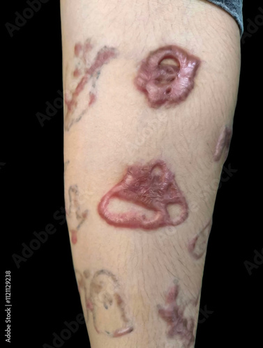 Keloid Scars on a Forearm photo