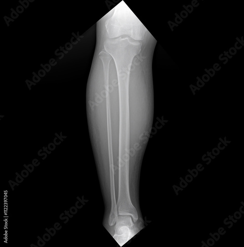 Knee x-rays for diagnostic purposes. meniscus tear. Bilateral Knee Joint radiographic image of both knees in anteroposterior view for detection of Osteoarthritis Knee. humerus Injuries. photo