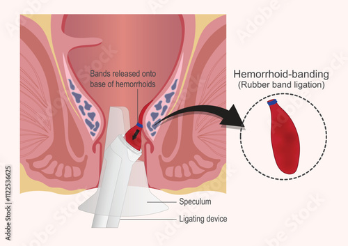 Hemorrhoid banding also called rubber band ligation.