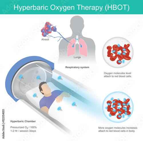 Hyperbaric Oxygen Therapy. A man has recumbent in tunnel glass for hyperbaric oxygen therapy pass by respiratory into blood vessel.