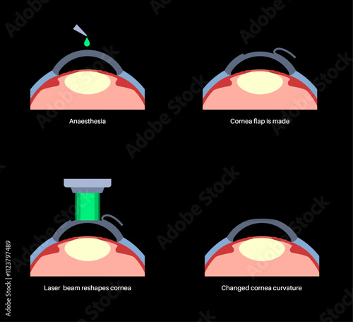 LASIK eye surgery