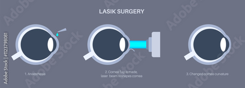 LASIK eye surgery