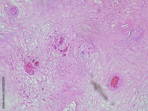 Photomicrograph of verruca vulgaris in the dextra pedis region under a microscope in the anatomical pathology laboratory photo