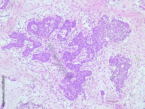 Photomicrograph pleomorphic adenoma in submandibular region tumor in anatomical pathology laboratory