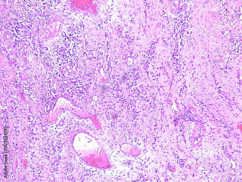 Photomicrograph Benign giant cell tumor (GCT) in the right leg area in the anatomical pathology laboratory photo