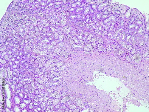 Human cell tissue under microscope in pathology laboratory. Microscopic picture of chronic gastric disease showing Helicobacter pylori bacterial infection, hematoxylin eosin staining photo