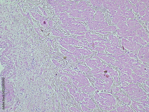 Photomicrograph of pyonephrosis + angiomyolipoma in a patient diagnosed with pyonephrosis sinistra in the anatomical pathology laboratory photo