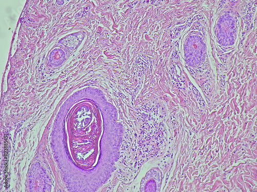 Photomicrograph showing histology of a atheroma cyst on the lobulus auricula in the anatomical pathology laboratory photo