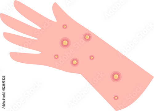 Injury Illustration. Blister hand