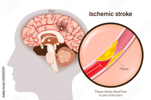 Ischemic stroke vector. Plaque blocks blood flow
to part of the brain. Diseased carotid artery. Atherosclerosis. Brain tissue death.