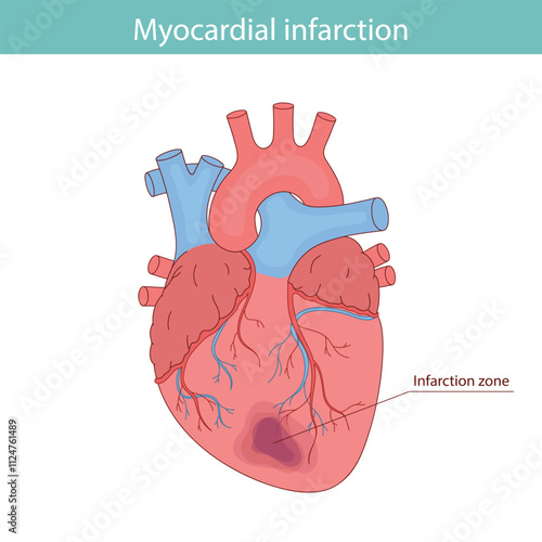 Myocardial infarction. Illustration of a human heart. Heart attack. Illustration in cartoon style