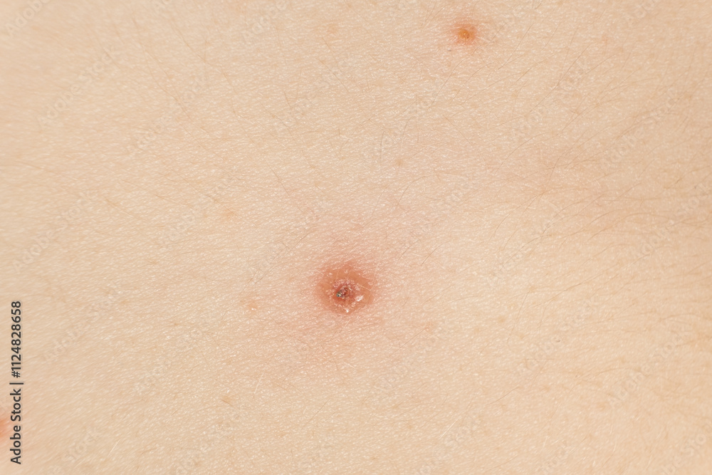 Fototapeta premium Macro skin with chickenpox, vesicles at different stages.