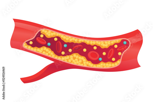 Type of cholesterol in human blood vessels. Narrowed artery for explanation diseases. Low-Density Lipoprotein LDL . Vector illustration