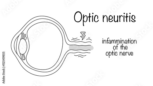 Optic neuritis