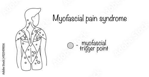 Myofascial pain syndrome