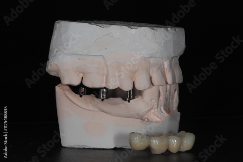 In dental and cosmetic dentistry, bone-anchored dental implant treatment with porcelain bridge prostheses and implant screws.
