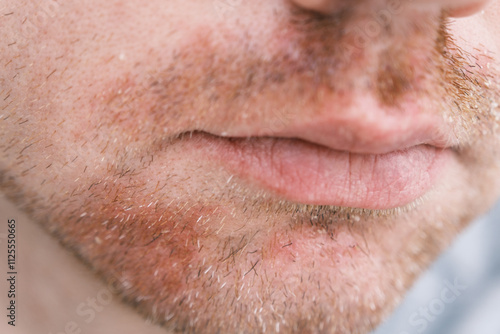 A close-up of a man's face with visible stubble and redness caused by seborrheic dermatitis, showing skin irritation and flaky patches.