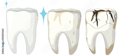 Stages of Tooth Decay Illustration