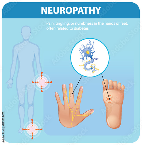 Understanding Neuropathy and Its Symptoms