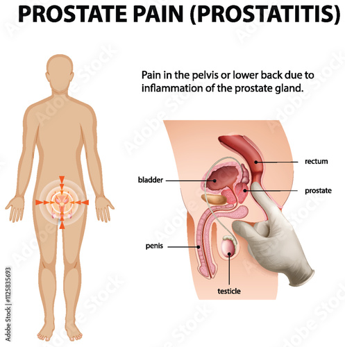 Understanding Prostate Pain and Inflammation