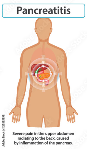 Understanding Pancreatitis and Its Symptoms